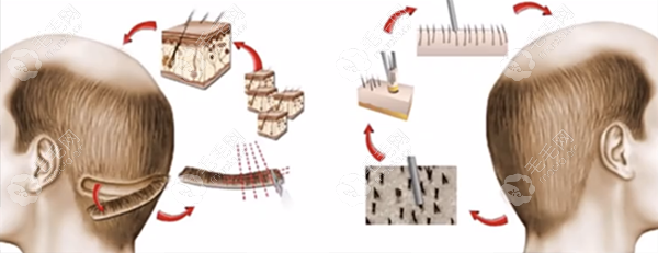 移植发际线fut和fue哪个好?可对比2种技术的存活率和疼痛感