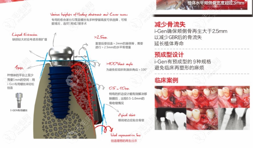 韩国美格真种植体多少钱？anyone型号和奥齿泰比哪个更贵