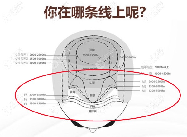 男士和女士前额植发情况示意图