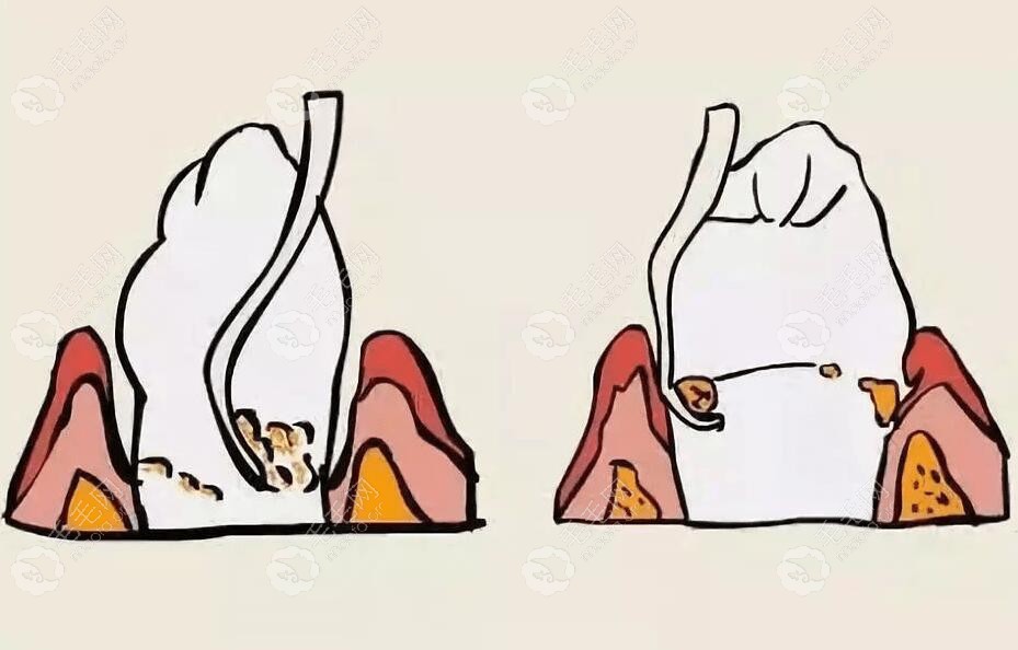 牙周治疗的基础操作