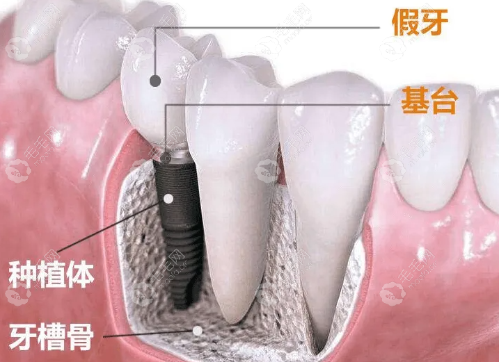 种植牙基台和牙冠是分开收费