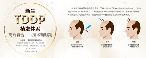 新生植发tddp植发技术介绍