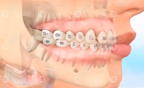 矫正器粘结位置示意