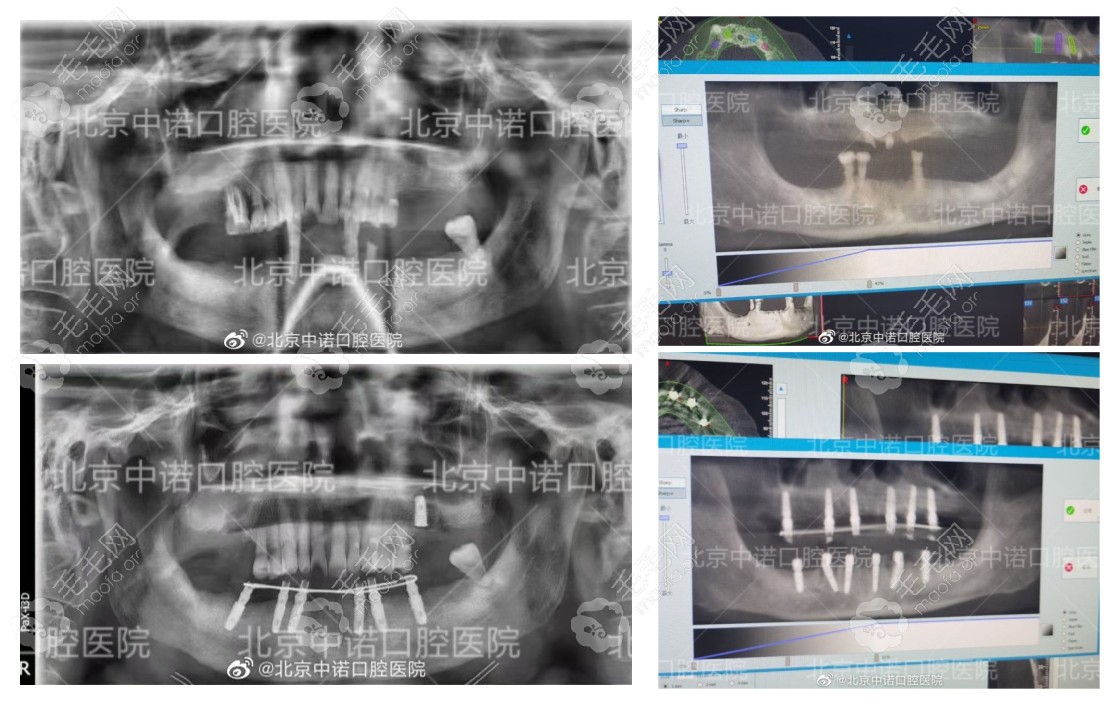 北京中诺口腔半口全口种植牙病例