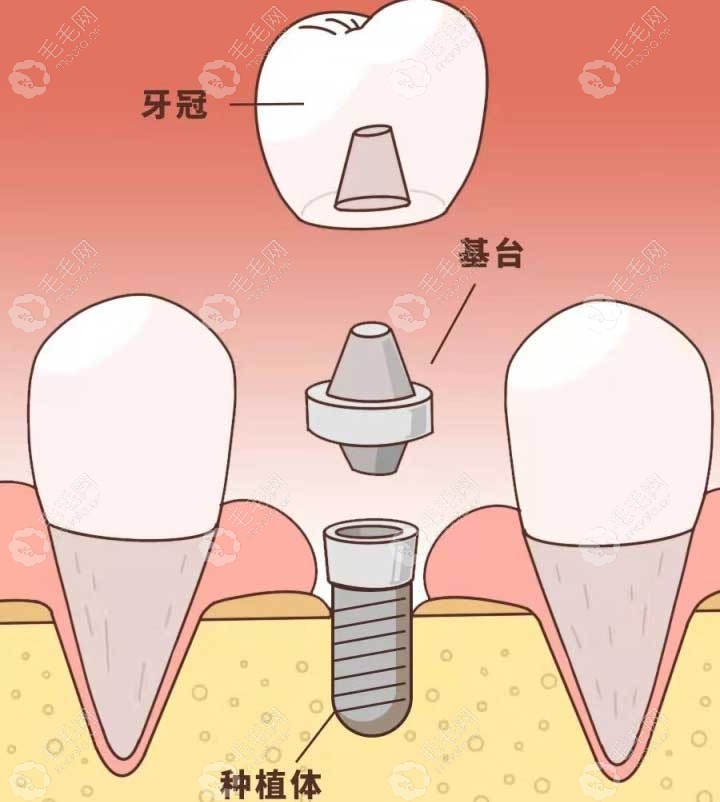 nobel active更适合门牙种植