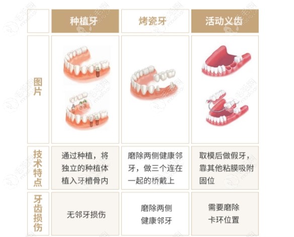 种植牙和搭桥牙哪个好