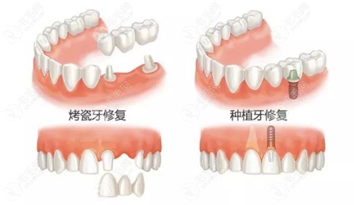 种植牙和搭桥牙哪个好?反正我后悔为了一颗牙搭桥不值得呀