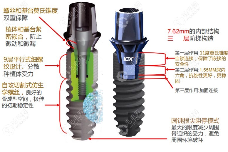 德国朗斯和ICX哪个种植体好用?价格差不多谁的寿命更长呢