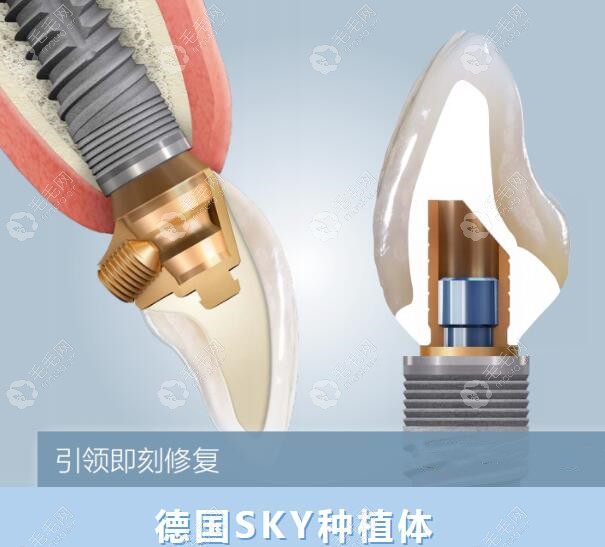 德国sky种植体的优点:价格便宜还能做半全口即刻负重种植牙