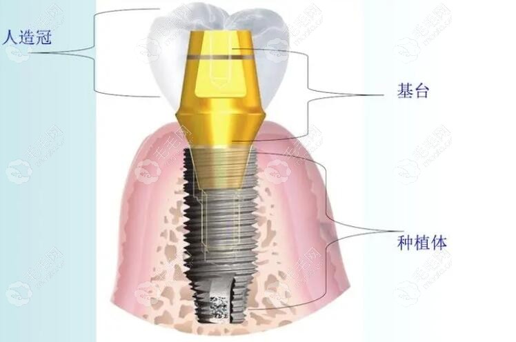 种植牙基台的区别
