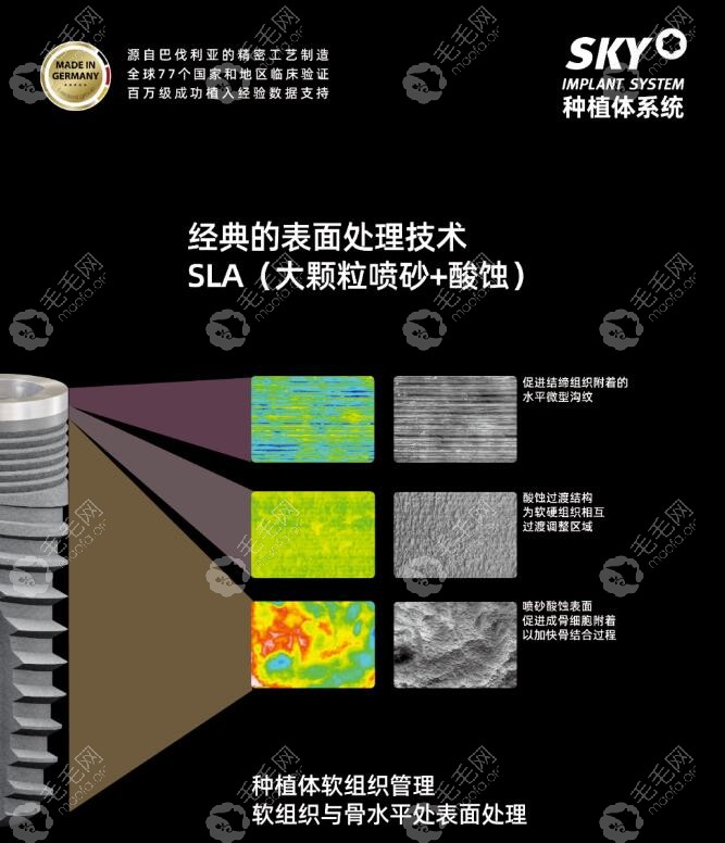 德国sky种植体可做半全口即刻负重种植