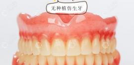 无种植仿生牙和活动义齿及种植牙有什么区别,不都是假牙嘛