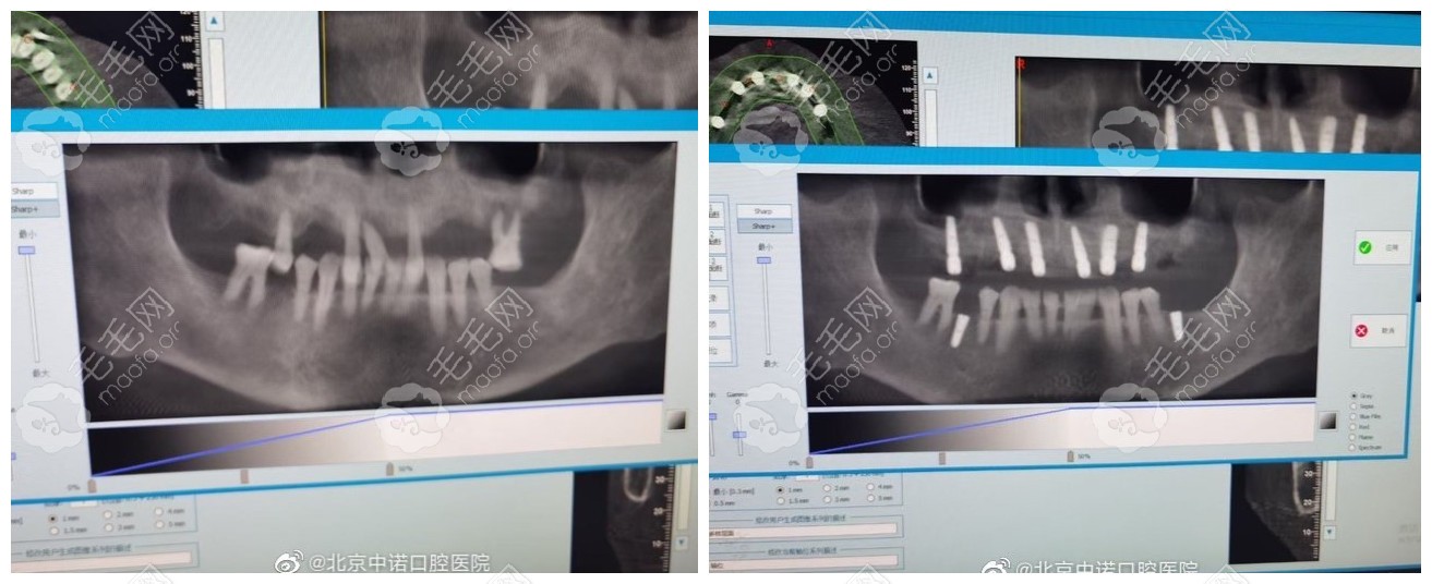 立得用半口种植牙病例对比
