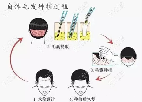 毛发移植手术过程