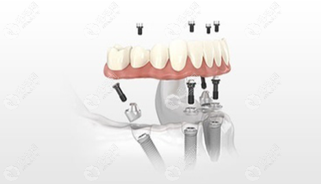 全口种植牙技术