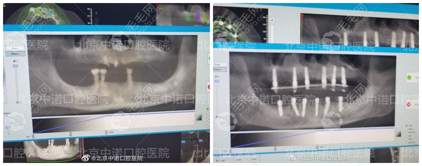 全口立得用种植牙病例