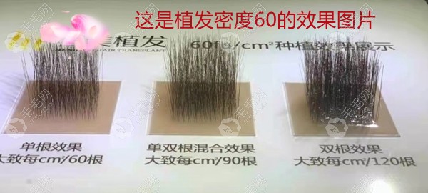 这个植发密度为60的展示图