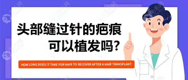 头部缝过针的疤痕可以植发吗?如果可以植发费用是多少钱