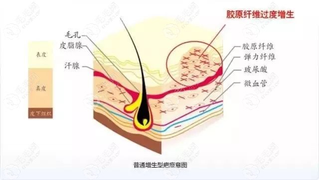 普通疤痕增生示意图