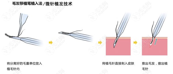 种植笔植发创口小