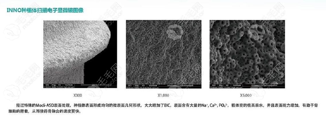 伊诺种植体的表面处理