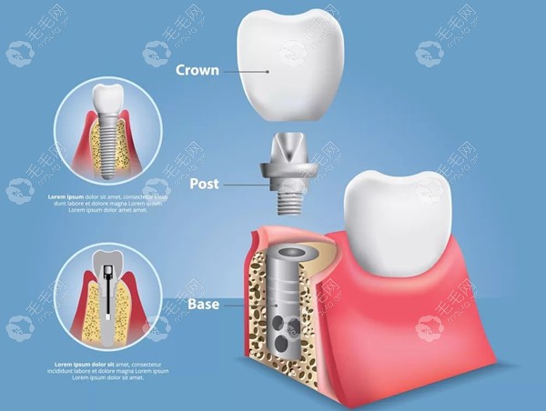 种植牙结构图