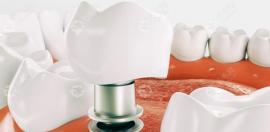 当天种牙当天吃饭是真的还是噱头?即刻负重就可即种即用哦