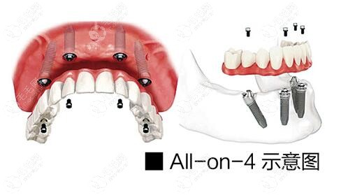 ALL-ON-4/6即刻负重种植牙只适合半全口种植吗？