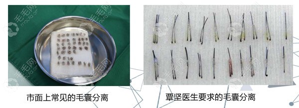 覃坚医生要求的毛囊分离之区别