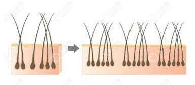 微针植发技术能降低对毛囊的二次损伤