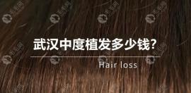 武汉中度植发多少钱?2000-3000单位差不多需要2万元左右