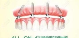 allon4/6即刻负重种植牙是什么意思?据说适合做半全口种植