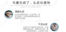 福州毛囊检测医院哪个好,去福州大麦/碧莲盛/看看吧