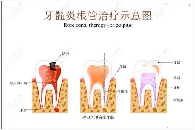 根管治疗步骤示意图