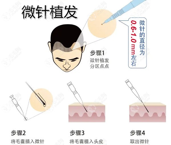 青岛微针植发技术