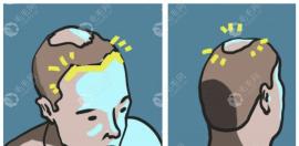 在呼和浩特植发哪里比较好?五洲/伊思/京美医院排名很高