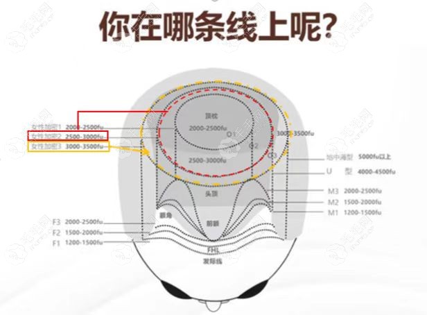 植发3000单位面积有多大