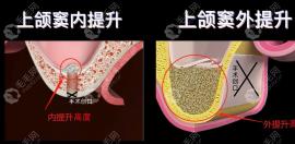種植牙內(nèi)提升和外提升的區(qū)別含:適應(yīng)癥/提升高度/術(shù)后反應(yīng)..