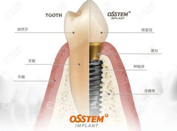 奥齿泰种植体是什么材质