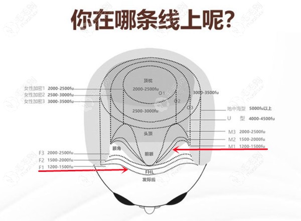 植发1000单位面积对比图示