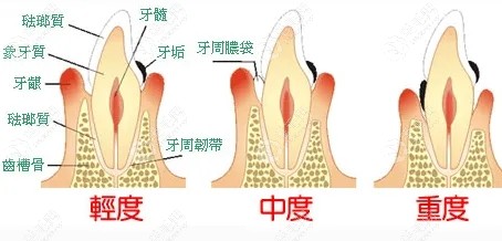 高血压糖尿病人能种植牙吗