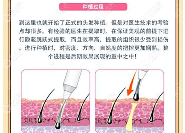 碧莲盛植发技术介绍