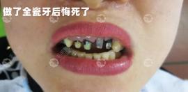 良心牙医不建议做全瓷牙,主因是牙齿磨小戴牙套后遗症太多