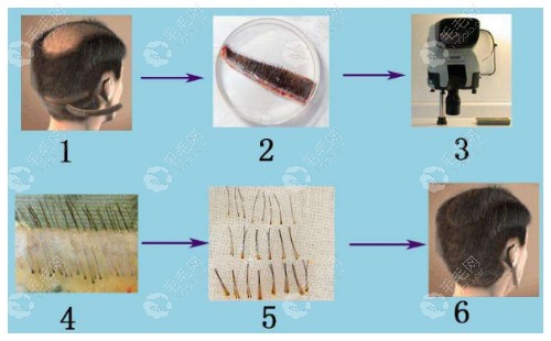 衢州新生植发操作步骤