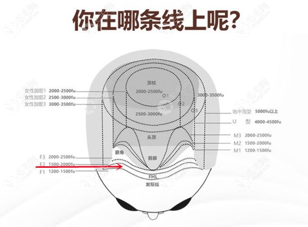 植发2000单位的面积