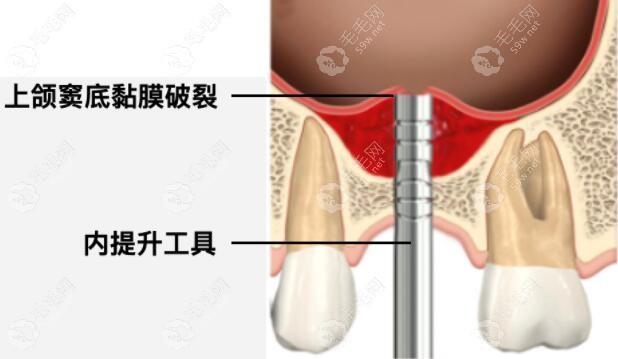 上颌窦内提升和外提升适应症的区别