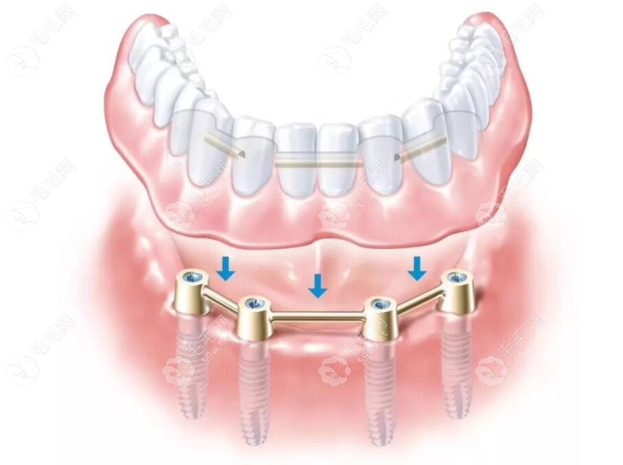 ALL-ON-4种植牙技术