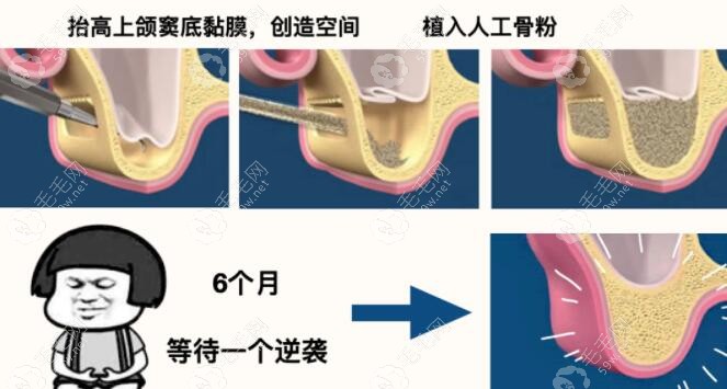 上颌窦内提升和外提升的手术方法不同