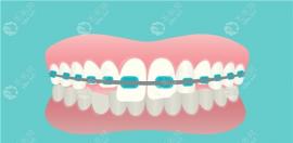 2025牙齿矫正价格是多少钱?自锁托槽一万六/隐形正畸两万起