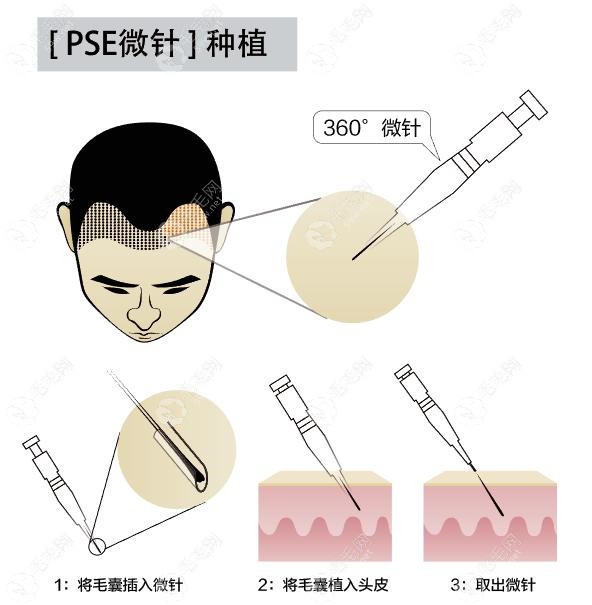 沈阳微针植发技术